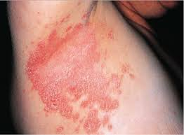 Canabinoides para alívio da Psoríase: como funciona? 6 Lesão de Psoríase Invertida. Fonte: ASSOCIAÇÃO NACIONAL DE PSORÍASE. Tipos de psoríase. Disponível em: https://psoriasebrasil.org.br/tipos-de-psoriase/.