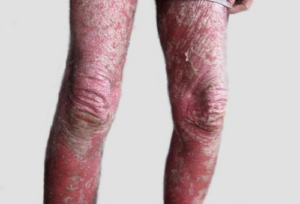 Canabinoides para alívio da Psoríase: como funciona? 4 Lesão de Psoríase Eritrodérmica. Fonte: ASSOCIAÇÃO NACIONAL DE PSORÍASE. Tipos de psoríase. Disponível em: https://psoriasebrasil.org.br/tipos-de-psoriase/.