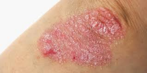 Canabinoides para alívio da Psoríase: como funciona? 1 Lesão de Psoríase em Placas. Fonte: ASSOCIAÇÃO NACIONAL DE PSORÍASE. Tipos de psoríase. Disponível em: https://psoriasebrasil.org.br/tipos-de-psoriase/.