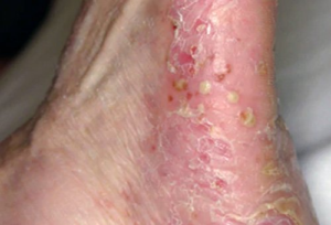 Canabinoides para alívio da Psoríase: como funciona? 3 Lesão de Psoríase Pustulosa. Fonte: ASSOCIAÇÃO NACIONAL DE PSORÍASE. Tipos de psoríase. Disponível em: https://psoriasebrasil.org.br/tipos-de-psoriase/.