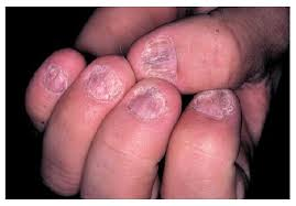 Canabinoides para alívio da Psoríase: como funciona? 5 Lesão de Psoríase Ungueal. Fonte: ASSOCIAÇÃO NACIONAL DE PSORÍASE. Tipos de psoríase. Disponível em: https://psoriasebrasil.org.br/tipos-de-psoriase/.