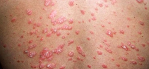 Canabinoides para alívio da Psoríase: como funciona? 2 Lesão de Psoríase Gutata. Fonte: ASSOCIAÇÃO NACIONAL DE PSORÍASE. Tipos de psoríase. Disponível em: https://psoriasebrasil.org.br/tipos-de-psoriase/.