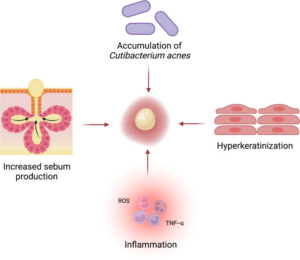 CBD e Acne: como o CBD atua na pele oleosa? 1 Patogênese da acne. Interação de aumento da produção de sebo, acúmulo de C. acnes, hiperqueratinização e inflamação, resultando na formação de comedões. Fonte: Peyravian, Nadia et al. “The Anti-Inflammatory Effects of Cannabidiol (CBD) on Acne.” Journal of inflammation research vol. 15 2795-2801.