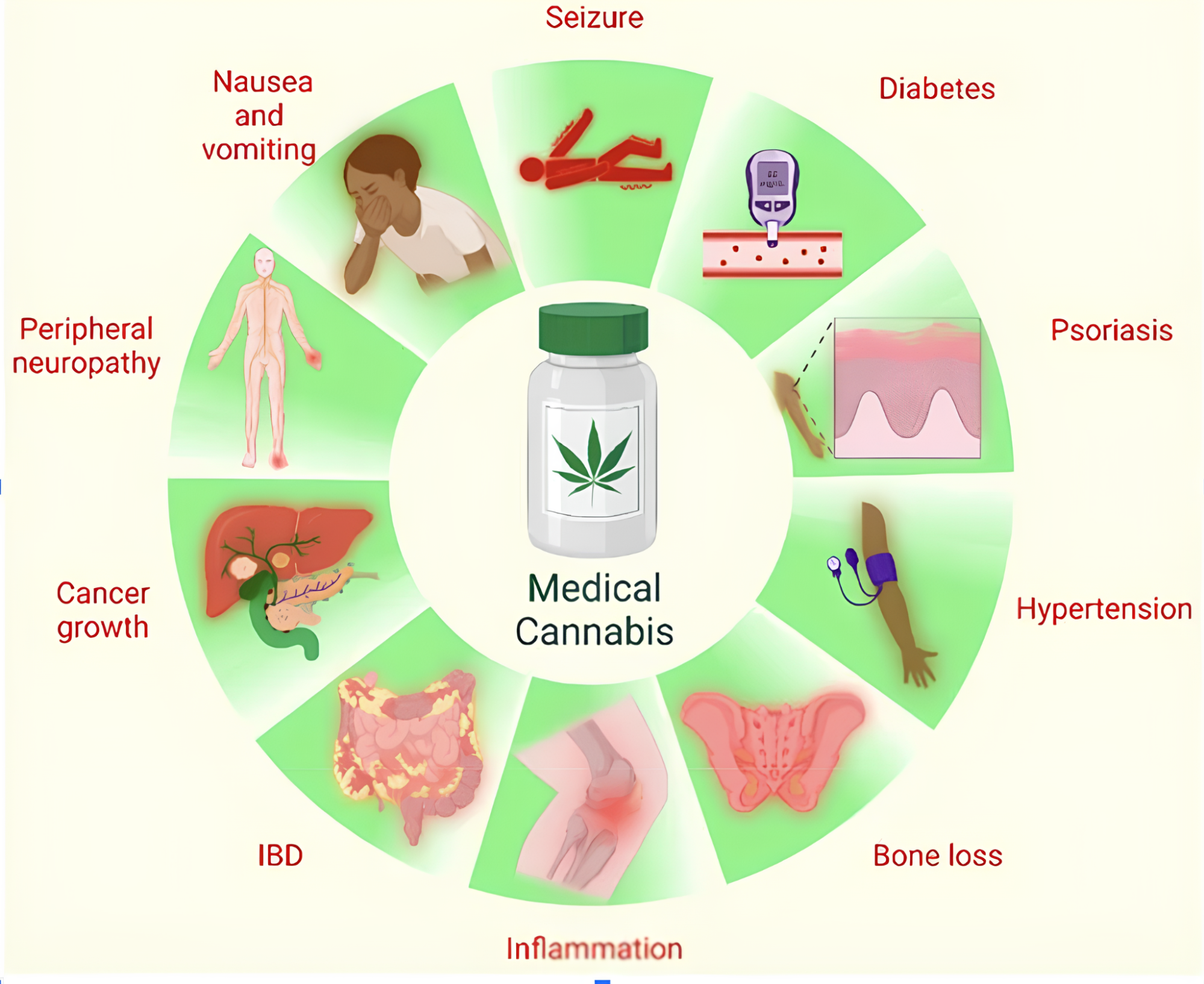 Medicina Personalizada no Tratamento com Cannabis 1 Uso medicinal da cannabis. A cannabis e diferentes fitocomponentes da cannabis, como THC e CBD, têm sido usados para várias terapias que incluem, mas não estão limitadas, ao tratamento de convulsões, vômitos e náuseas, neuropatia periférica, dor crônica; psoríase; redução do crescimento de células cancerígenas, perda óssea e distúrbio inflamatório intestinal; sendo usada como anti-inflamatório e anti-hipertensivo; além de redução do nível de glicose no sangue. Fonte: Leinen, Z.J.; Mohan, R.; Premadasa, L.S.; Acharya, A.; Mohan, M.; Byrareddy, S.N. Therapeutic Potential of Cannabis: A Comprehensive Review of Current and Future Applications. Biomedicines 2023, 11, 2630.