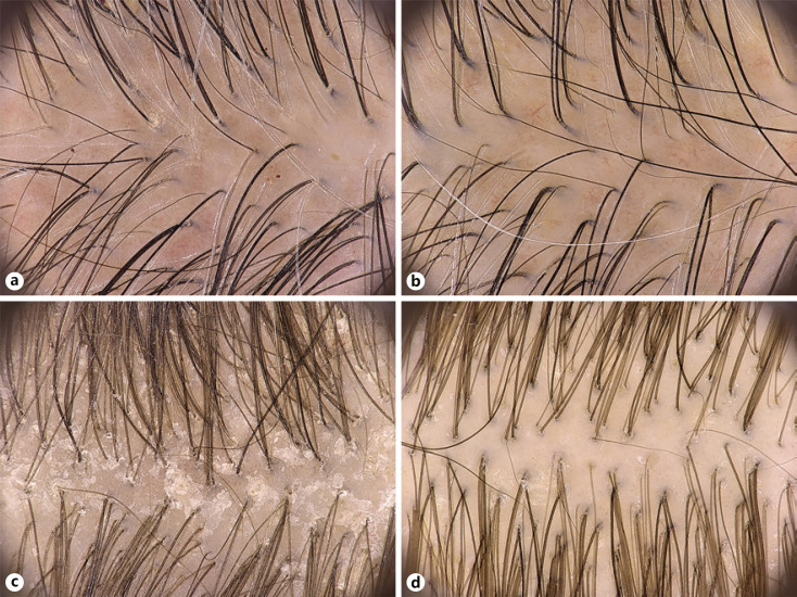 Canabidiol para controle da Seborreia: eficácia e benefícios 2 Exemplos representativos da eficácia do shampoo de CBD do estudo de Vincenzi, C. & Tosti usando videodermoscopia em indivíduos com dermatite seborreica (a, b) e psoríase do couro cabeludo (c, d). DS, dermatite seborreica. Fonte: Vincenzi, C. & Tosti, A. Eficacy and Tolerability of a Shampoo Containing Broad-Spectrum Cannabidiol in the Treatment of Scalp Inflammation in Patients with Mild to Moderate Scalp Psoriasis or Seborrheic Dermatitis. Skin Appendage Disord. 6,355-361 (2020).