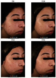 CBD e Acne: como o CBD atua na pele oleosa? 3 Imagem representativa da evolução clínica com o uso da formulação tópica de CBD com terpenos naturais extraídos de plantas como Centella asiática e Silybum marianum. Fonte: Cohen, G., Jakus, J., Baroud, S., Gvirtz, R. & Rozenblat, S. Development of an Effective Acne Treatment Based on CBD and Herbal Extracts: Preliminary In Vitro, Ex Vivo, and Clinical Evaluation. Evid. Based Complement. Alternat. Med. 2023, 1-8 (2023).