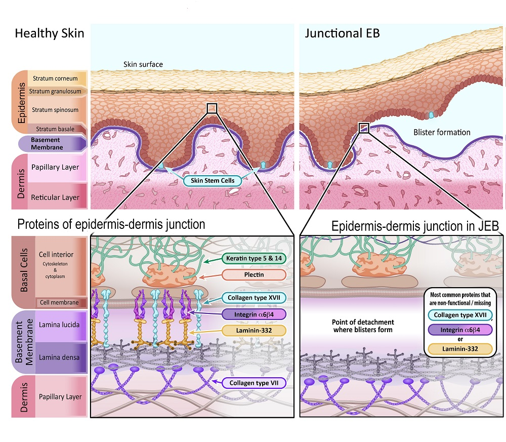 Cannabis e o tratamento da Epidermólise Bolhosa 2 Imagem representando a pele saudável em comparação com a pele afetada pela Epidermólise Bolhosa Juncional.Fonte: EUROPEAN GENE AND CELL THERAPY CONSORTIUM (EuroGCT). Epidermolysis Bullosa: How could gene and cell therapy help? Available at: https://www.eurogct.org/epidermolysisbullosa.