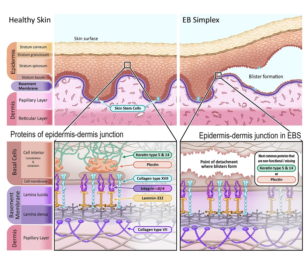 Cannabis e o tratamento da Epidermólise Bolhosa 1 Imagem Representando a pele saudável em comparação com a pele afetada pela Epidermólise Bolhosa Simples. Fonte: EUROPEAN GENE AND CELL THERAPY CONSORTIUM (EuroGCT). Epidermolysis Bullosa: How could gene and cell therapy help? Available at: https://www.eurogct.org/epidermolysisbullosa.