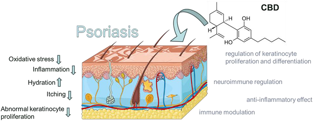 Cannabis no tratamento da psoríase: o que diz a ciência? 2 A figura destaca os possíveis mecanismos de ação do canabidiol no tratamento da psoríase. A ação do CBD pode reduzir a inflamação, o estresse oxidativo, a coceira, a proliferação anormal de queratinócitos e pode aumentar a hidratação. Adaptado de smart SERVIER MEDICAL. SISTEMA TEGUMENTAR ART. 2024. Disponível a partir de https://smart.servier.com/smart_image/integumentary-system/.