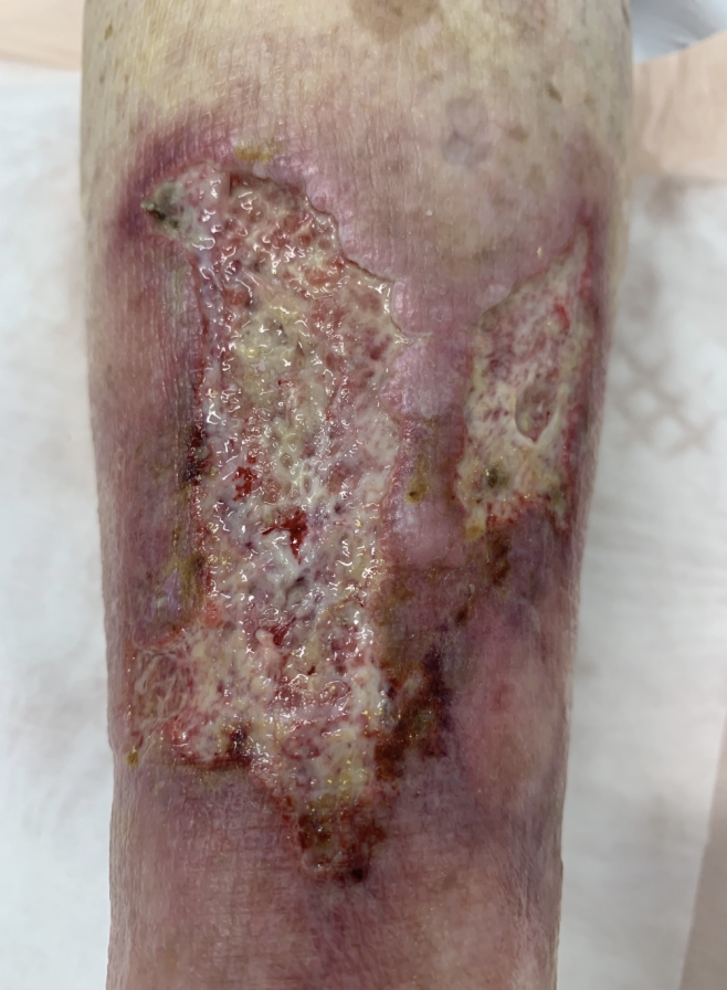 O papel dos Canabinoides na cicatrização de feridas difíceis 3 Representação evolutiva do processo de cicatrização de ferida crônica em membro inferior do paciente de 74 anos com calcifilaxia não urêmica e múltiplas comorbidades no dia 0 do tratamento. O tratamento foi realizado com aplicações diárias de uma formulação à base de cannabis tópica (CBD 3,75mg/mL + terpenoide-𝛽-Cariofileno + flavonoides com quercetina, diosmina e hesperidina). A ferida foi completamente fechada após 74 dias de tratamento. Extraído de Maida et al. (2020b).