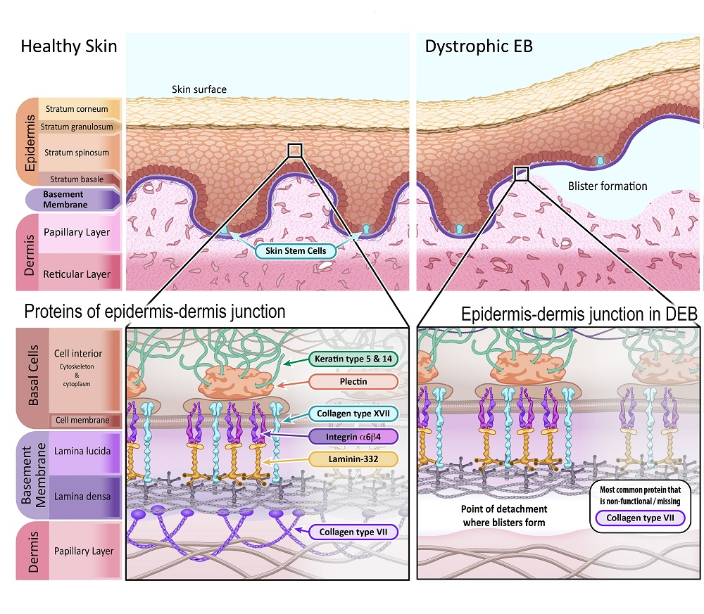 Cannabis e o tratamento da Epidermólise Bolhosa 3 Imagem representando a pele saudável em comparação com a pele afetada pela Epidermólise Bolhosa Distrófica. Fonte: EUROPEAN GENE AND CELL THERAPY CONSORTIUM (EuroGCT). Epidermolysis Bullosa: How could gene and cell therapy help? Available at: https://www.eurogct.org/epidermolysisbullosa.