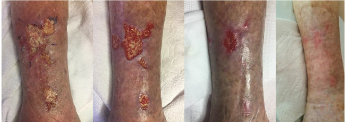 O papel dos Canabinoides na cicatrização de feridas difíceis 2 Imagens evolutivas do processo de cicatrização de ferida crônica em membro inferior do paciente de 85 anos com calcifilaxia não urêmica e múltiplas comorbidades (dias 0, 27, 54 e 74). O tratamento foi realizado com aplicações diárias de uma formulação à base de cannabis tópica (CBD 3,75mg/mL + terpenoide-𝛽-Cariofileno + flavonoides com quercetina, diosmina e hesperidina). A ferida foi completamente fechada após 74 dias de tratamento. Extraído de Maida et al. (2020a)