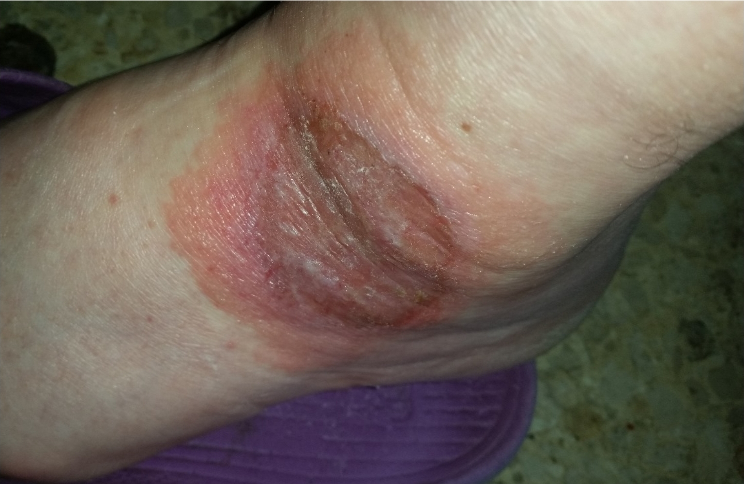 Caso clínico - Psoríase 2 Lesão em região em dorso do pé