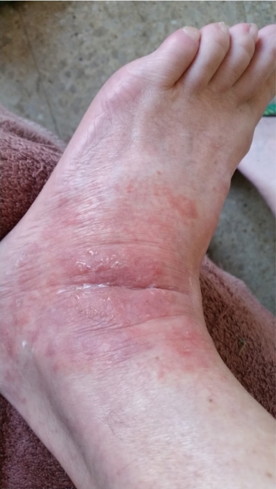 Caso clínico - Psoríase 3 Lesão em região em dorso do pé