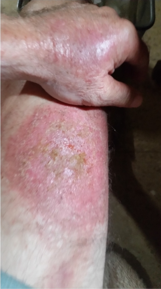 Caso clínico - Psoríase 5 Lesões em mão e coxa direita