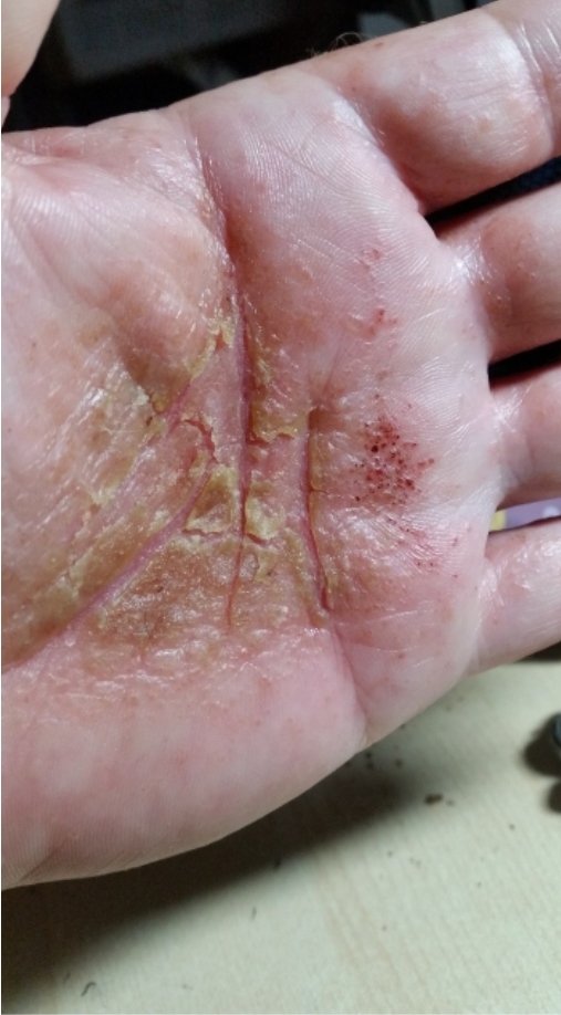 Caso clínico - Psoríase 4 Lesão em região palmar