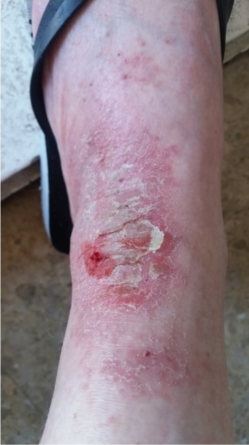 Caso clínico - Psoríase 6 Lesão em pé esquerdo