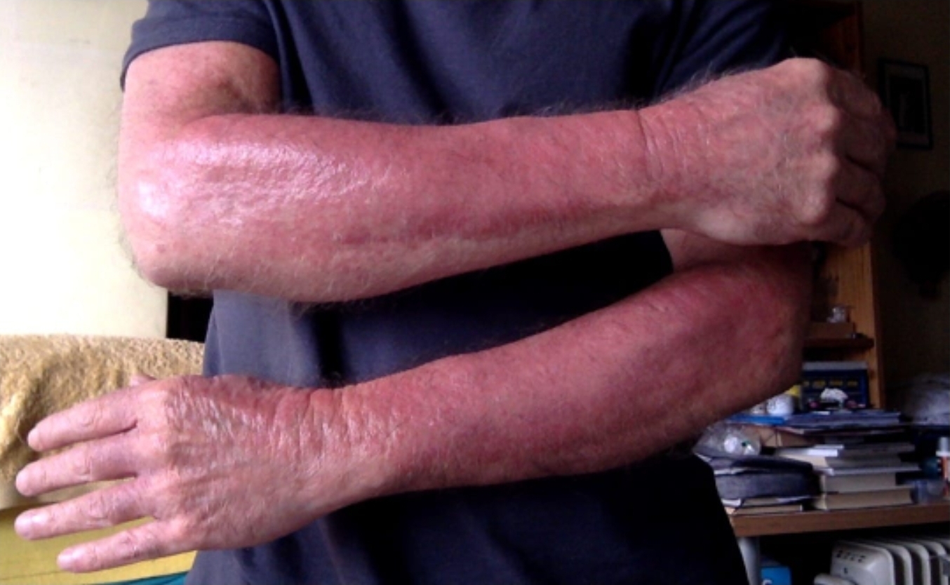 Caso clínico - Psoríase 7 Antes do início do tratamento