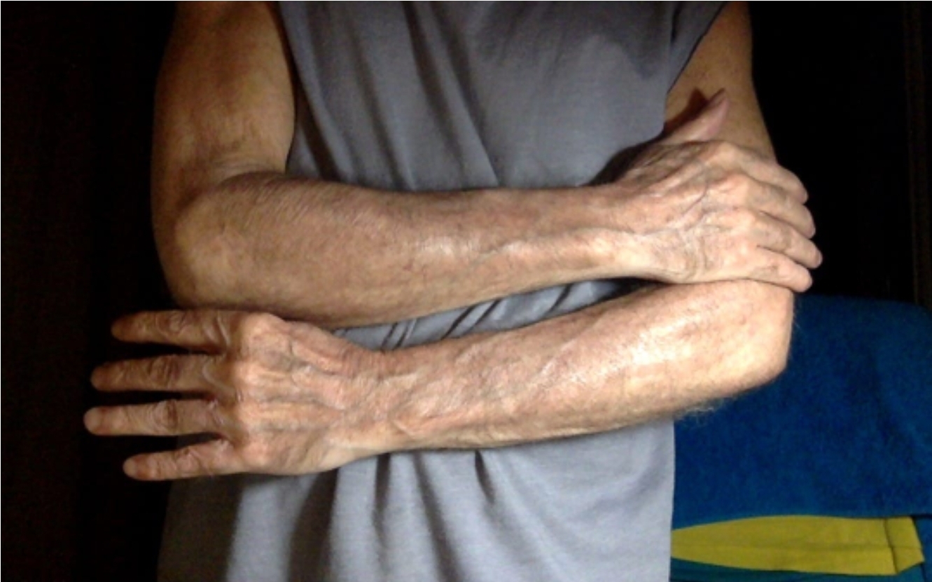 Caso clínico - Psoríase 8 10 dias após o início do tratamento com a nova abordagem terapêutica.