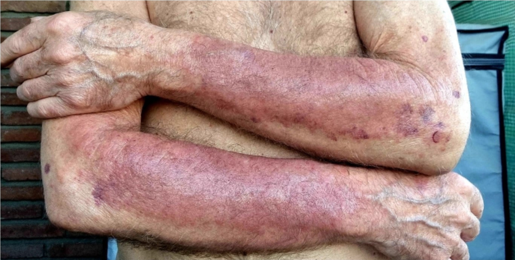 Caso clínico - Psoríase 9 Lesões do último surto, ocorrido em abril de 2024.