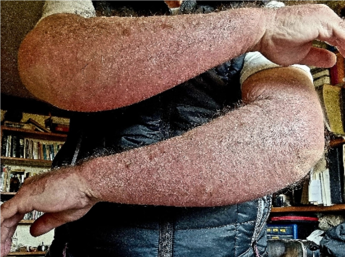 Caso clínico - Psoríase 10 Lesões do último surto, ocorrido em abril de 2024.