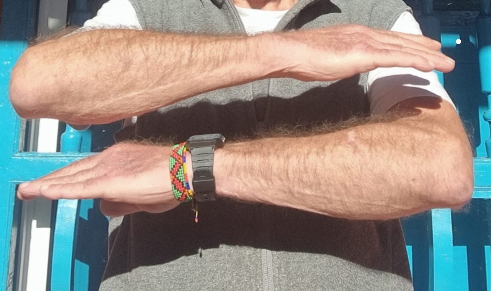 Caso clínico - Psoríase 12 Atualmente o paciente se mantém estável com a abordagem terapêutica à base de Cannabis medicinal.