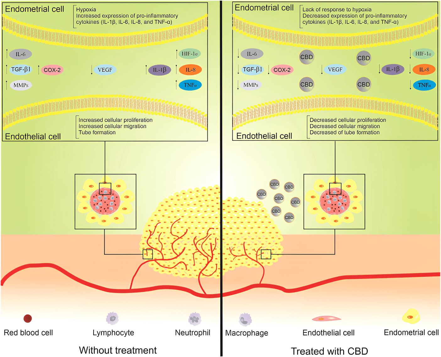 Uso de CBD para alívio da dor na Endometriose e Adenomiose 1 Esta figura ilustra as moléculas envolvidas na patogênese da endometriose que podem ser alvo do canabidiol. O lado esquerdo é a condição de endometriose sem tratamento e o lado direito é com o tratamento com o canabidiol. O tratamento pode reduzir o número de células endometriais por meio da inibição da angiogênese e da inflamação. CBD, canabidiol; HIF-1α, fator induzível por hipóxia 1α; IL, interleucina; MMP, metaloproteinase da matriz; TGF-β, fator de crescimento transformador β; TNF-α, fator de necrose tumoral α; VEGF, fator de crescimento endotelial vascular. Fonte: Anvari Aliabad, Roghayeh et al. “Cannabidiol as a possible treatment for endometriosis through suppression of inflammation and angiogenesis.” Immunity, inflammation and disease vol. 12,8 (2024).