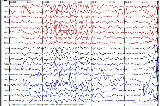 Caso Clínico: O impacto da cannabis medicinal no desenvolvimento de uma paciente com Epilepsia Refratária e Atraso Global 2 Resultado do Eletroencefalograma