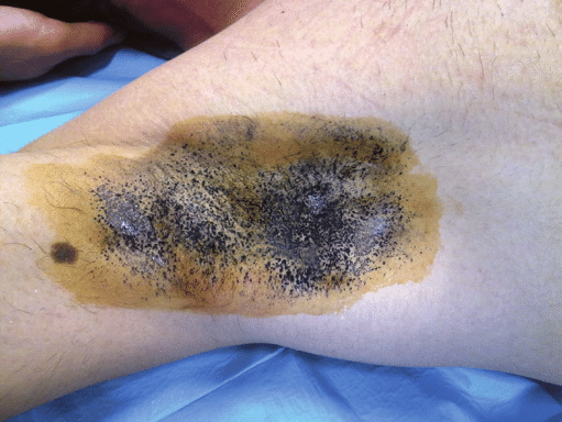 Caso clínico - Hiperidrose Hereditária tratada com cannabis 2 Teste de Minor na hiperidrose axilar direita. O Teste de Minor identifica áreas de suor excessivo através da reação entre iodo e amido, formando manchas escuras onde há hiperidrose. Método simples, indolor e essencial para guiar. Fonte: Reis, Gilberto & Silva Guerra, Ana & Ferreira, João. (2011). Study of patients with hyperhidrosis treated with botulinum toxin: a 10-year retrospective analysis. Revista Brasileira de Cirurgia Plástica. 26. 582-590. 10.1590/S1983-51752011000400008.