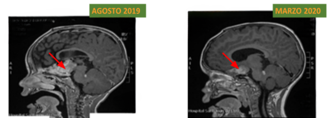 Casos Clínicos: Astrocitoma Pilomixoide em paciente pediátrico 3 RNM do encéfalo em corte sagital.